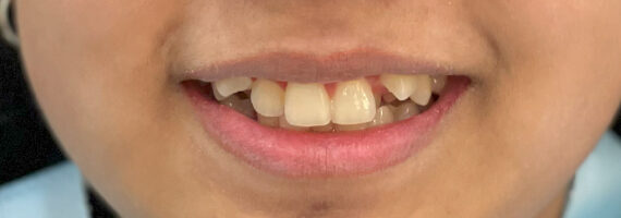 braces-before