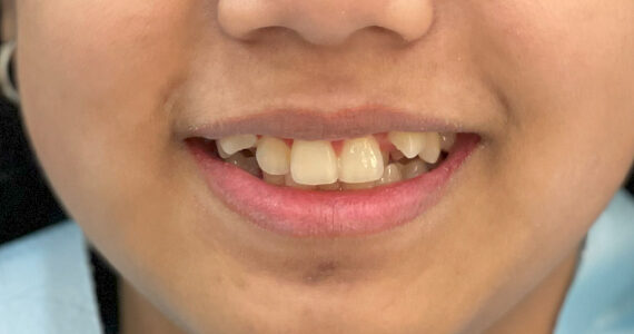 braces-before