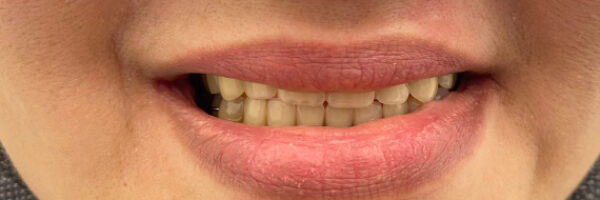 best-denture-treatment-after-dubai