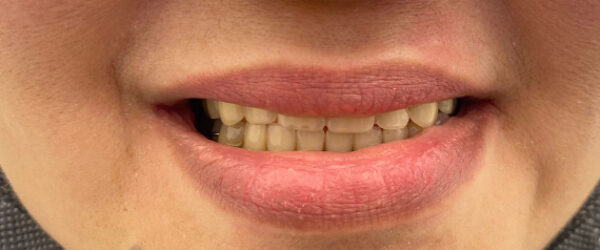 best-denture-treatment-after-dubai