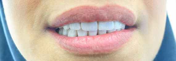 before-dental-10