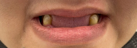 before-dental