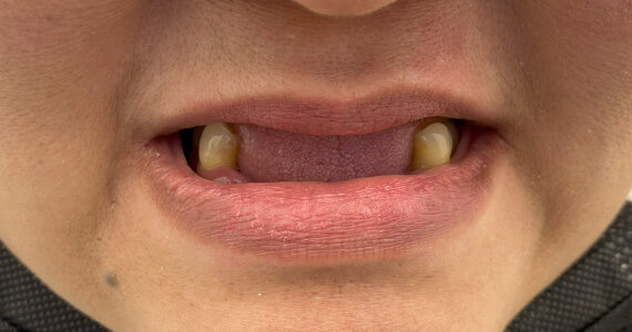 before-dental