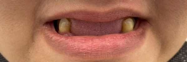 best-denture-treatment-dubai-before best-denture-treatment-dubai-before