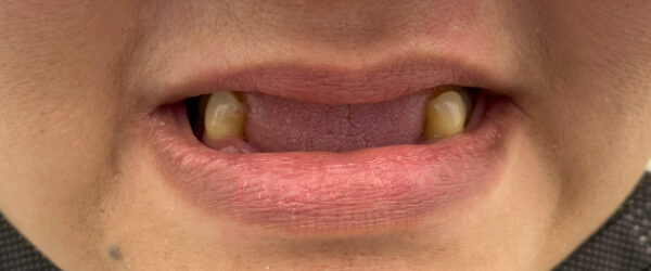 best-denture-treatment-dubai-before best-denture-treatment-dubai-before