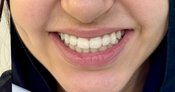 braces-after09