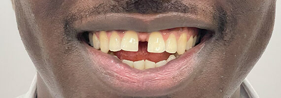 braces-after12
