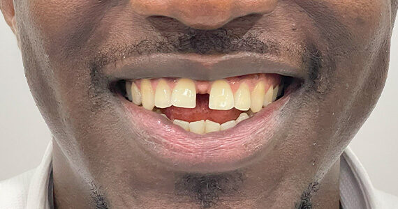 braces-after12