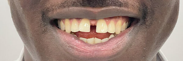 braces-treatment-dubai-before braces-treatment-dubai-before