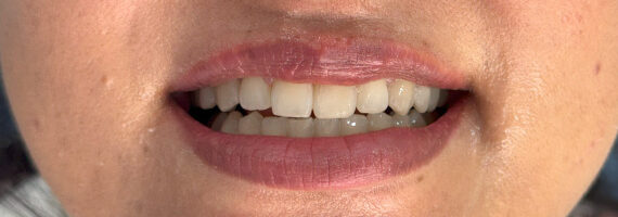 braces-after34