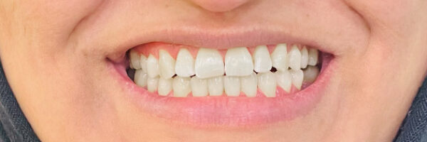 best-braces-treatment-dubai-after