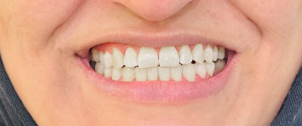 best-braces-treatment-dubai-after
