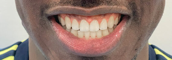 braces-before12