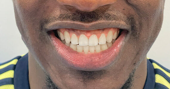 braces-before12