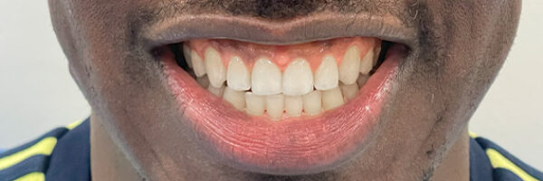 braces-treatment-dubai-after