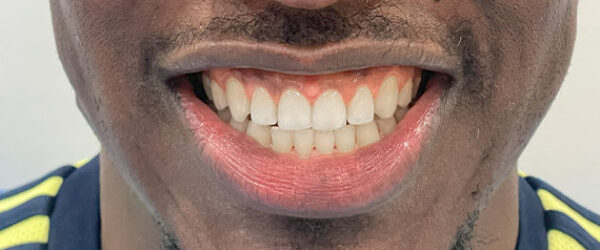 braces-treatment-dubai-after