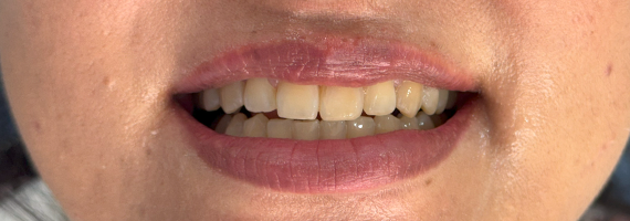 braces-before33 braces-before33