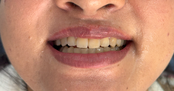 braces-before33 braces-before33