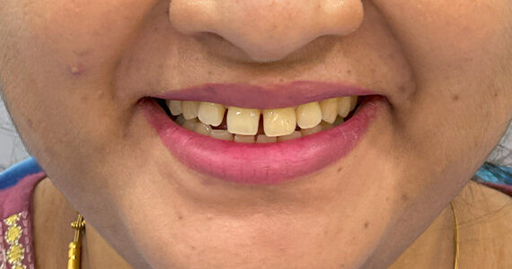 braces-before344