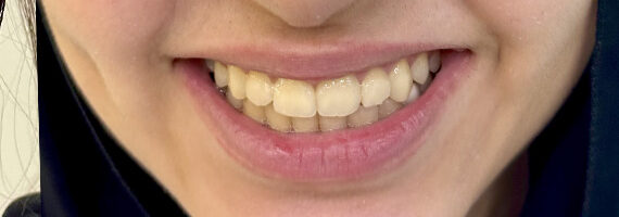 braces-before455