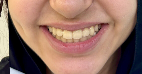 braces-before455