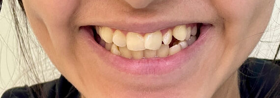 braces-before4555