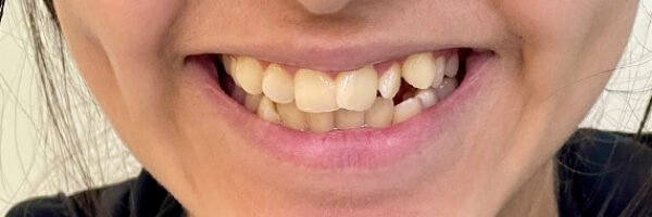 braces-before4555 braces-before4555