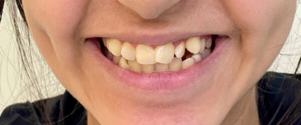 braces-before4555 braces-before4555