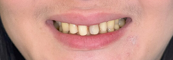 braces-before55