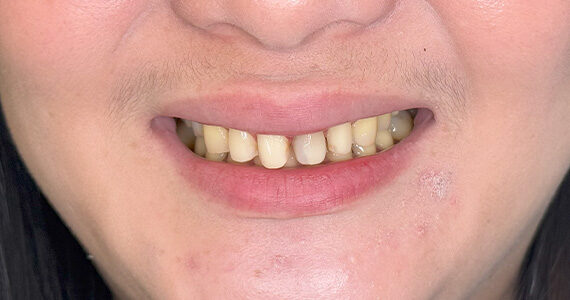 braces-before55