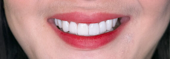 braces-before556
