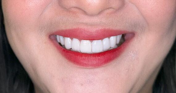 braces-before556