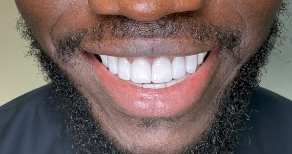 braces-before66