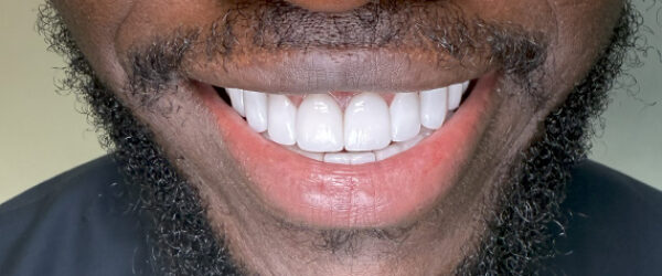 Dental-veneer-treatment-dubai-after