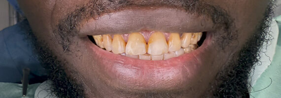 braces-before666