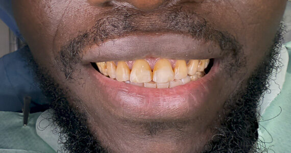 braces-before666