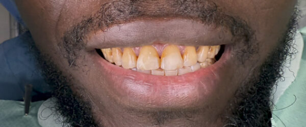 Dental-veneer-treatment-dubai-before