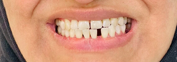 braces-before77