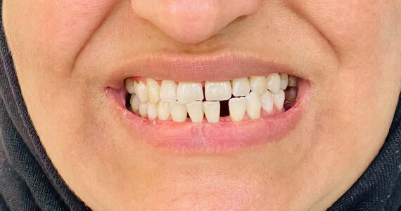 braces-before77