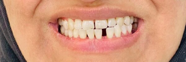 best-braces-treatment-dubai-before