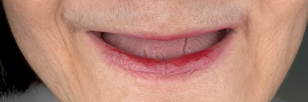 braces-before777 braces-before777