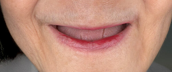 braces-before777 braces-before777