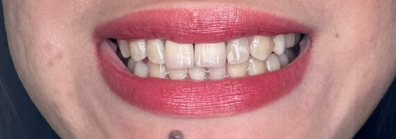 braces-before88