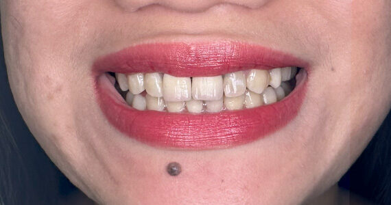 braces-before88