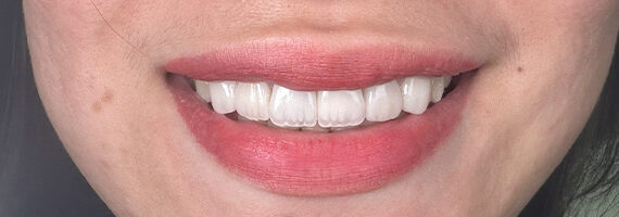 braces-before888