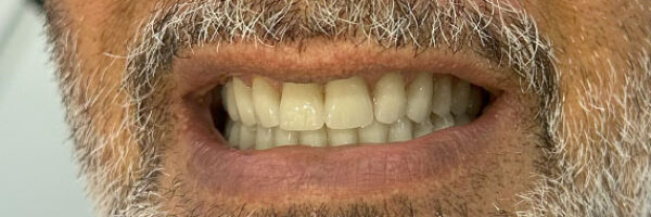 denture-treatment-dubai-after