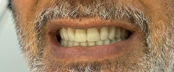 denture-treatment-dubai-after