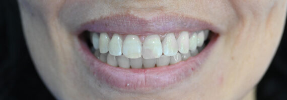 dental-after 2