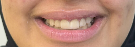 best-dental-veneer-treatment-dubai-after