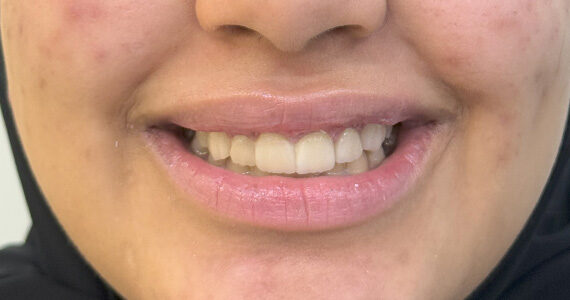 best-dental-veneer-treatment-dubai-after